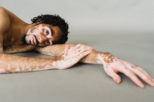 Homme Noir Avec Vitiligo Allongé Sur Le Plancher Du Studio