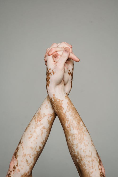 Hands of person with vitiligo against gray background