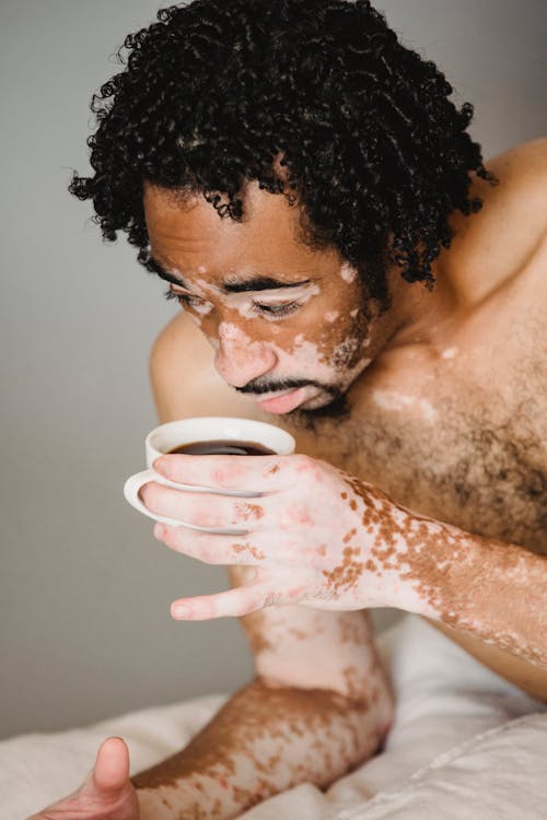 Thoughtful African American man with vitiligo skin lying on bed and drinking cup of coffee against gray background
