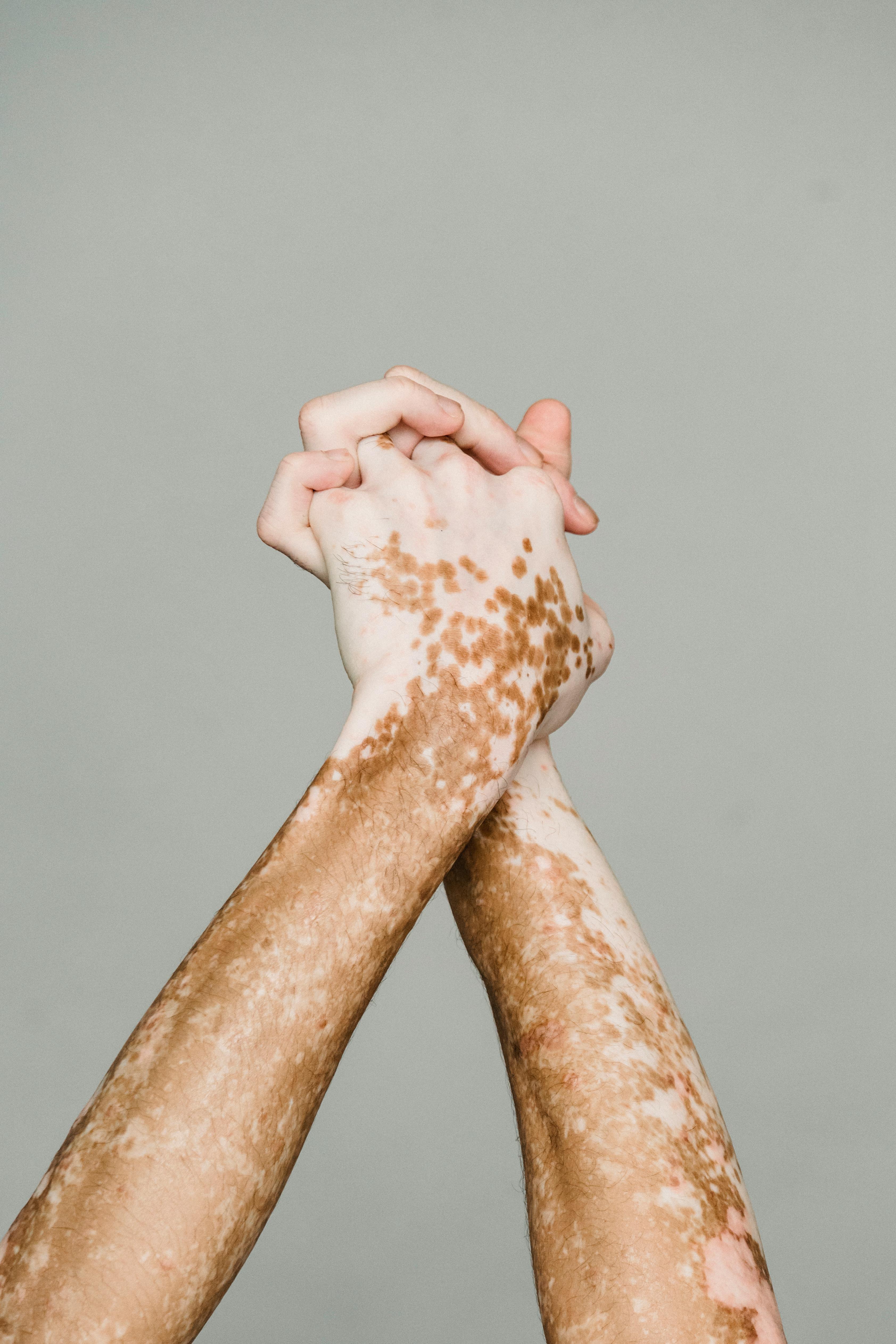 crossed hands with vitiligo skin against gray background