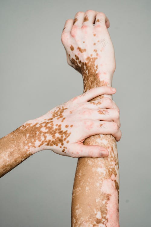 Free Arms Of A Person With Skin Problem Stock Photo