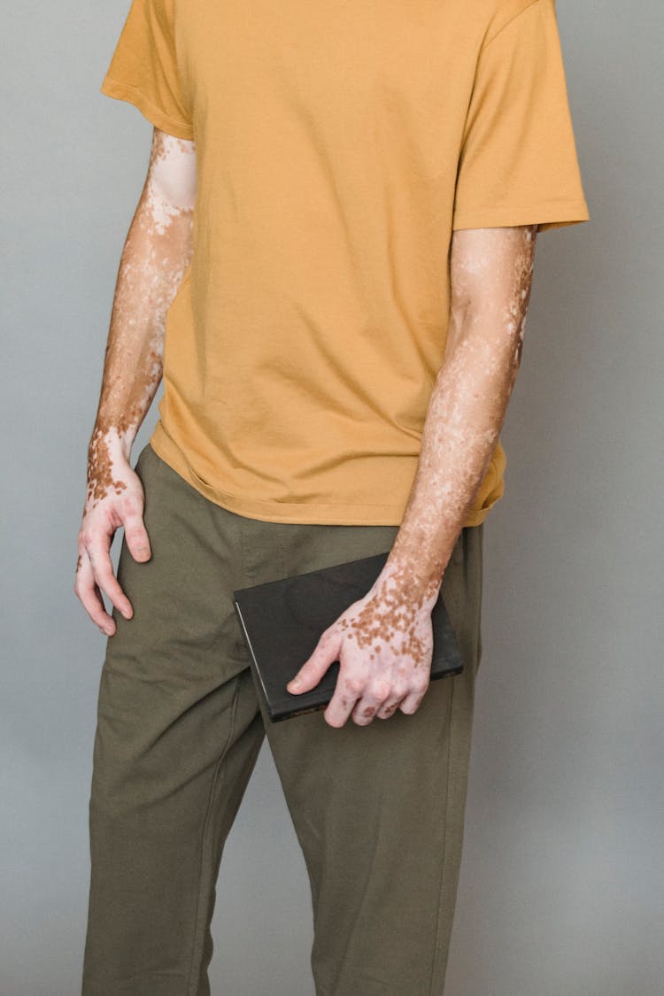 Crop Man With Vitiligo Standing With Notebook In Hand
