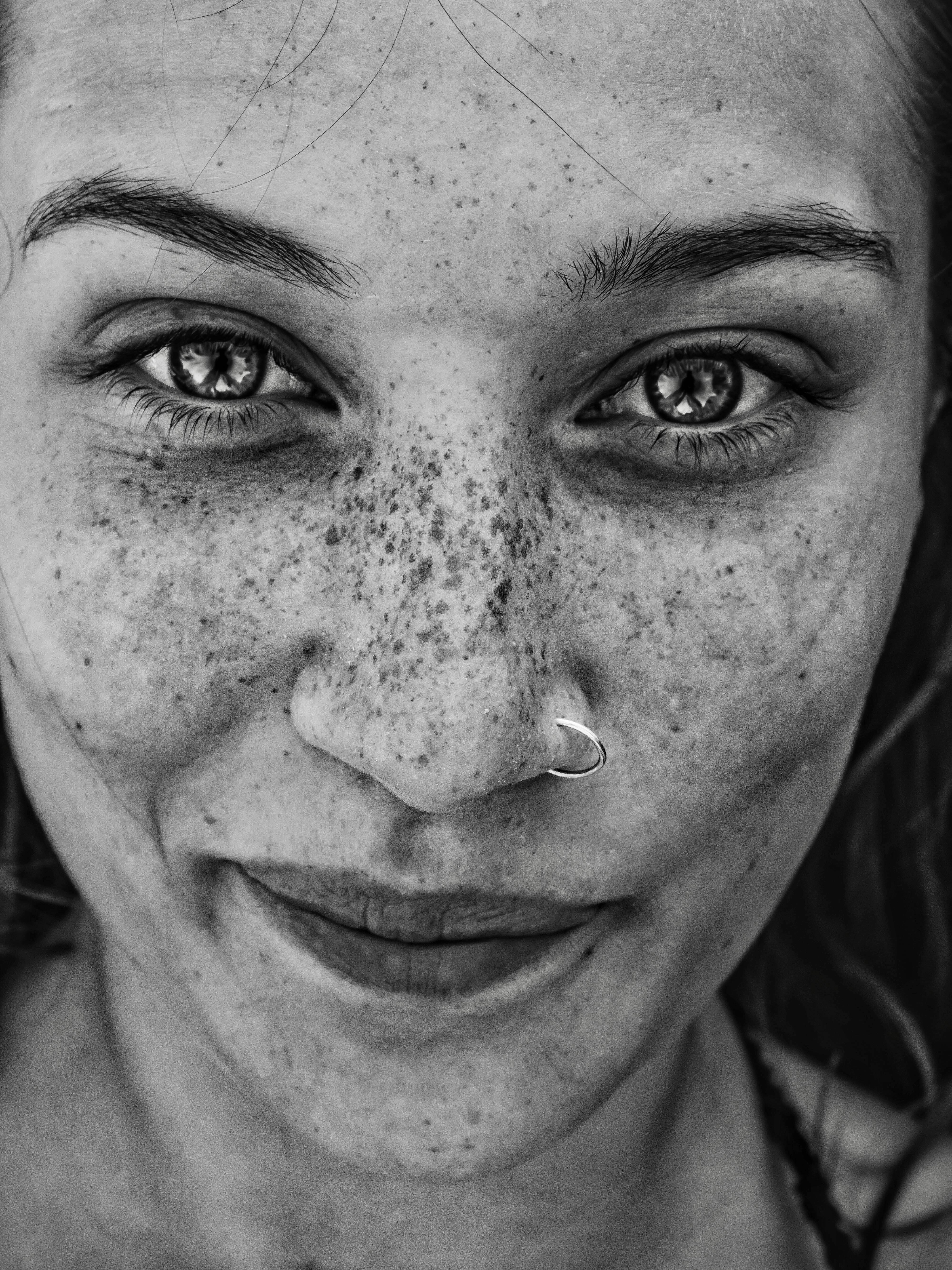 Broken capillaries on the face