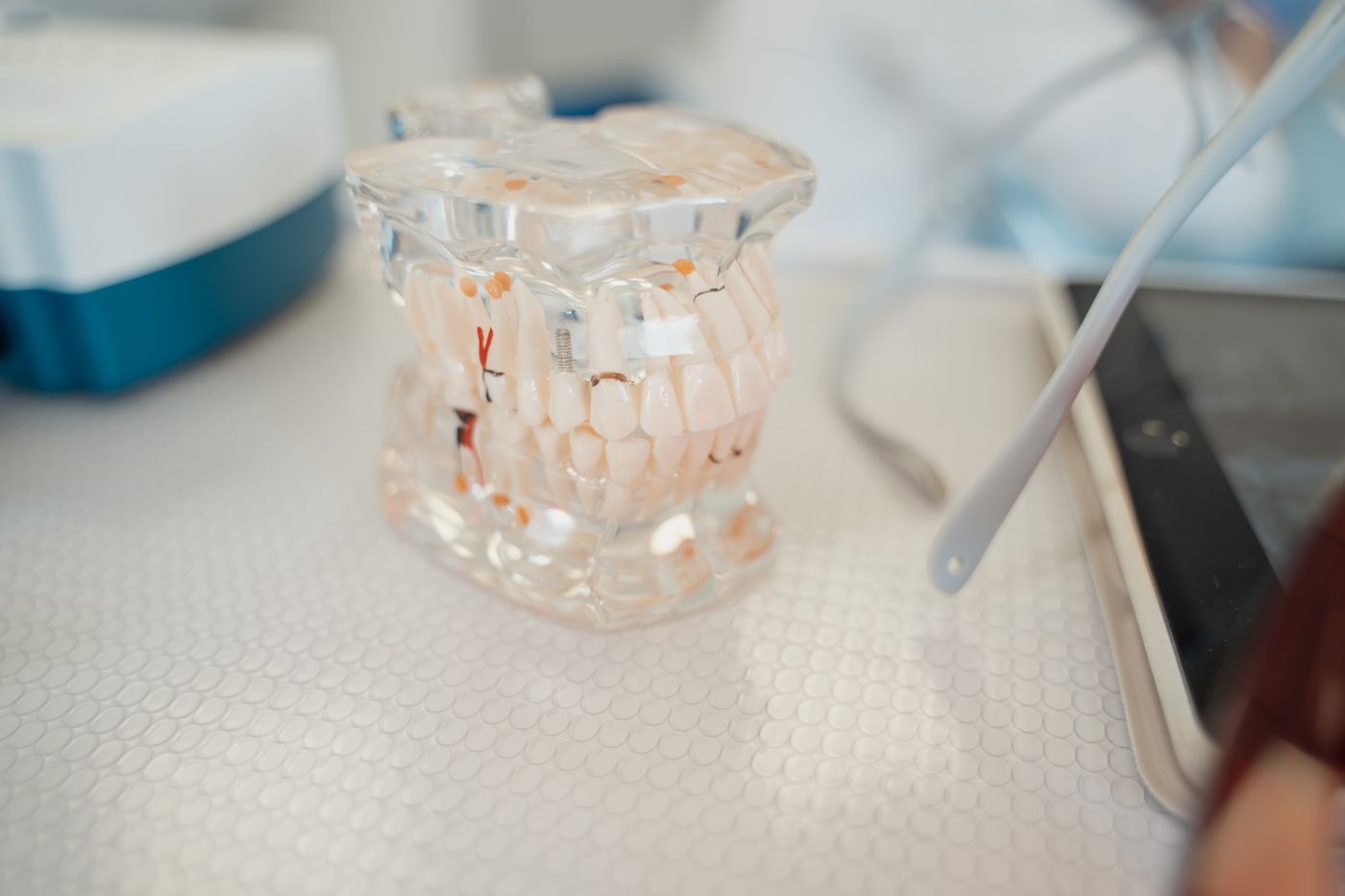 Close-up ceramic dental restoration model