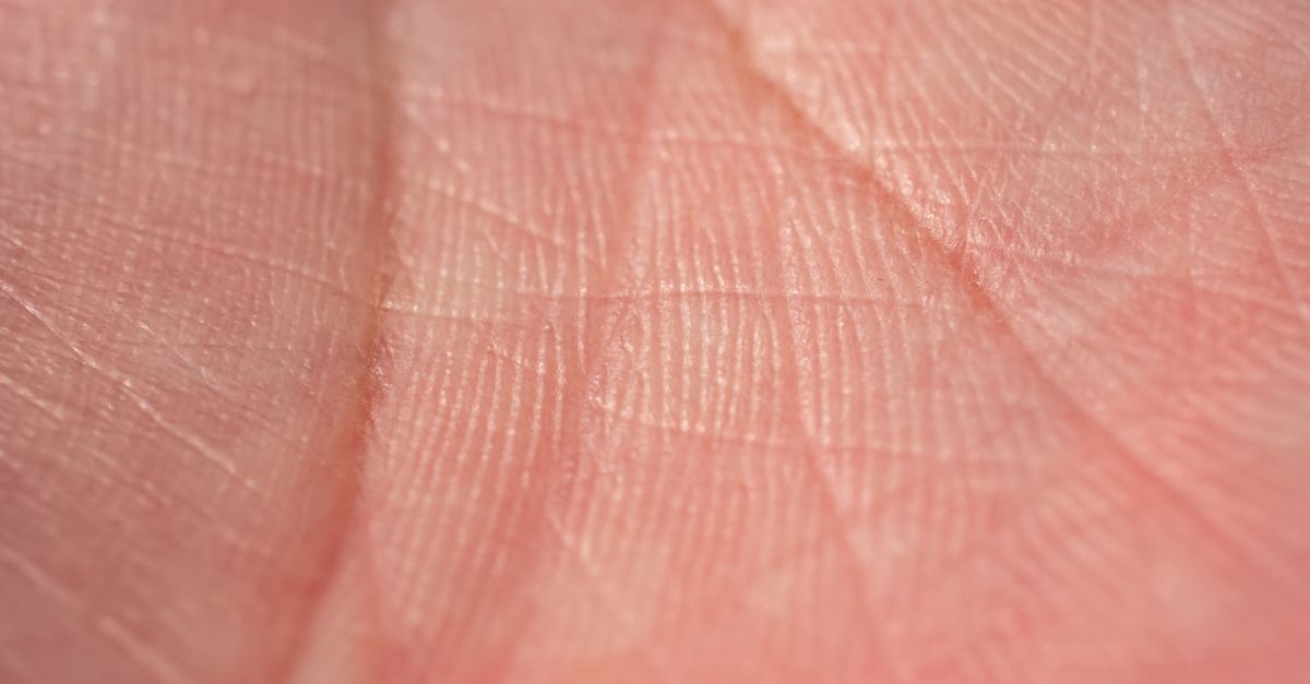臉部泛紅看似過敏卻可能是玫瑰斑!調查顯示8成生活受影響