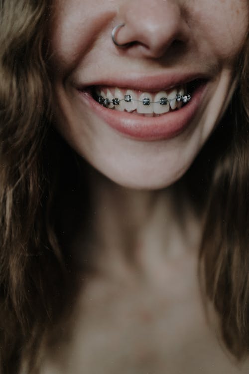 Crop woman smiling and demonstrating teeth braces