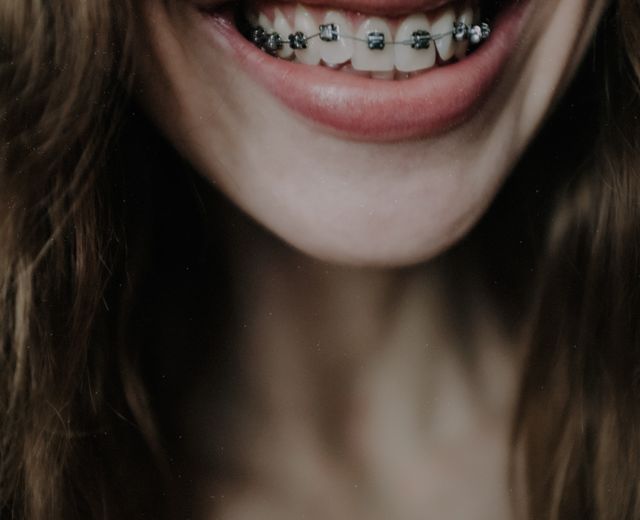 After braces & aligners at Ohud Dental, Lahore