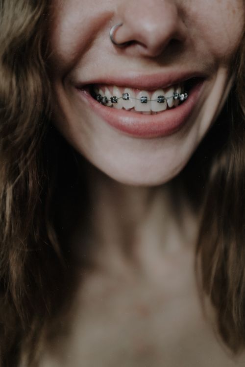 Close-up of a young woman smiling with metal braces — orthodontic treatment in progress