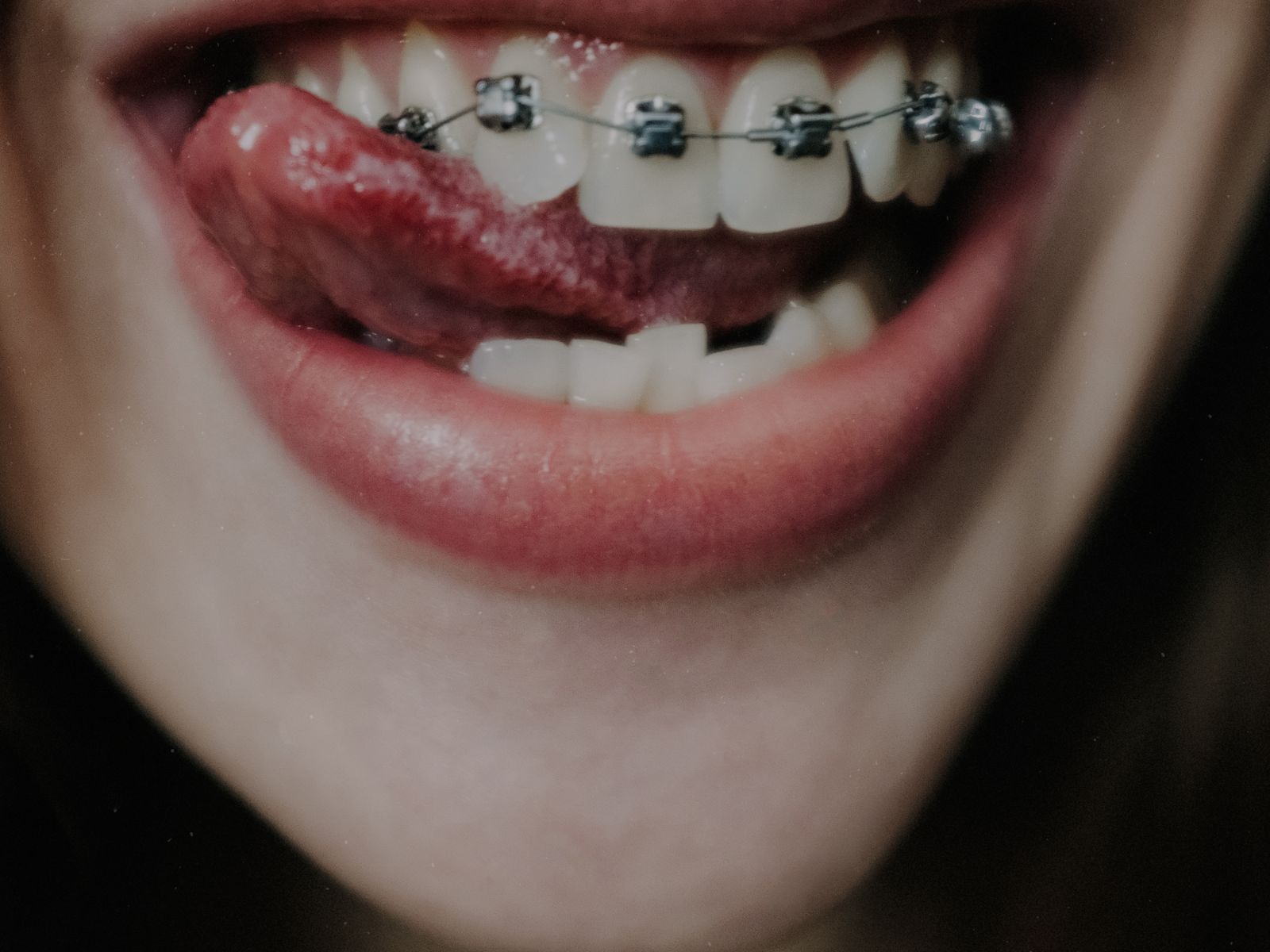 Smiling young adult showing orthodontic braces