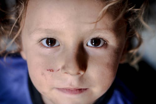 Cute little boy with brown eyes and scratch on face