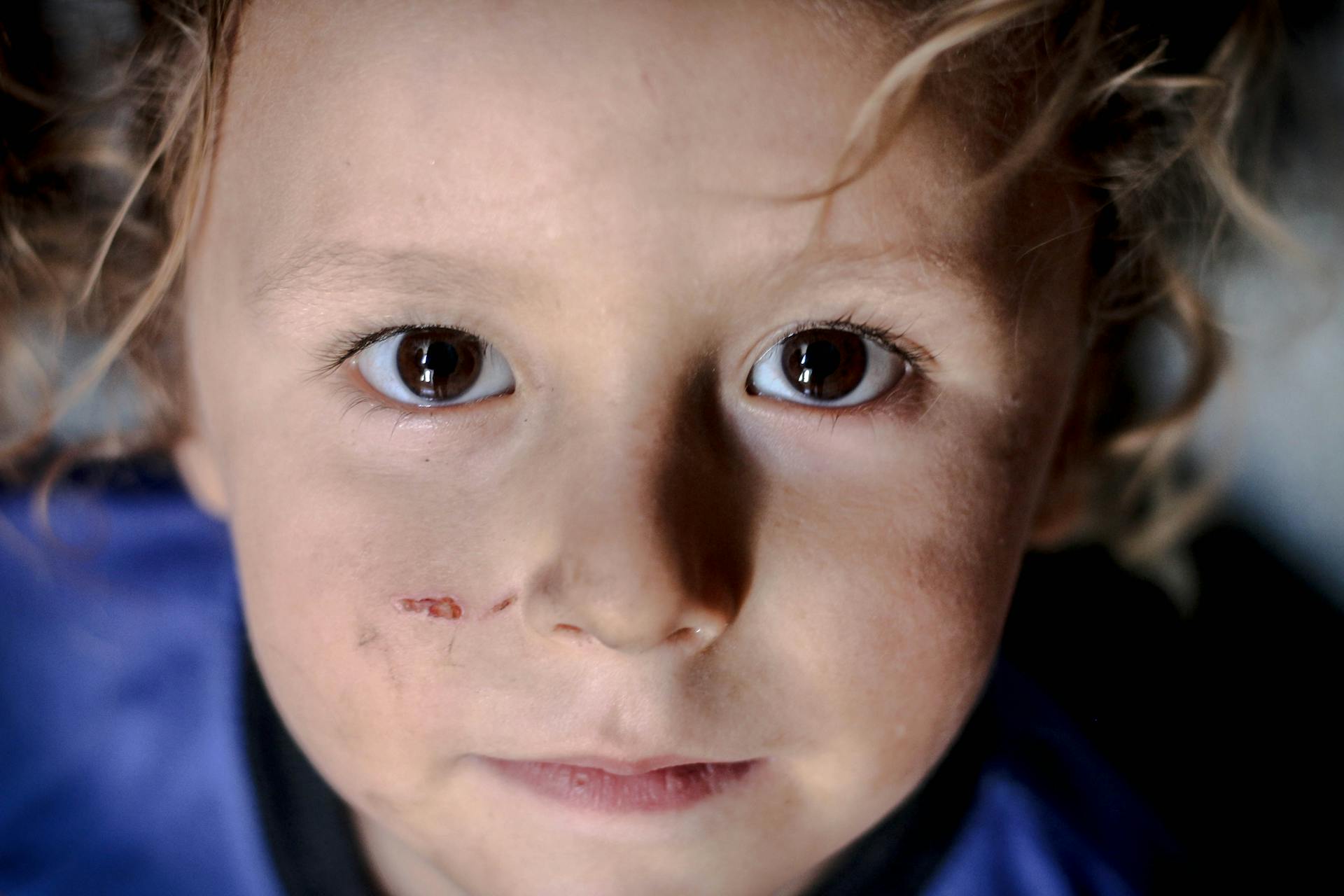 Intimate portrait of a young child with curly hair and a scratch on the face, looking directly at camera.