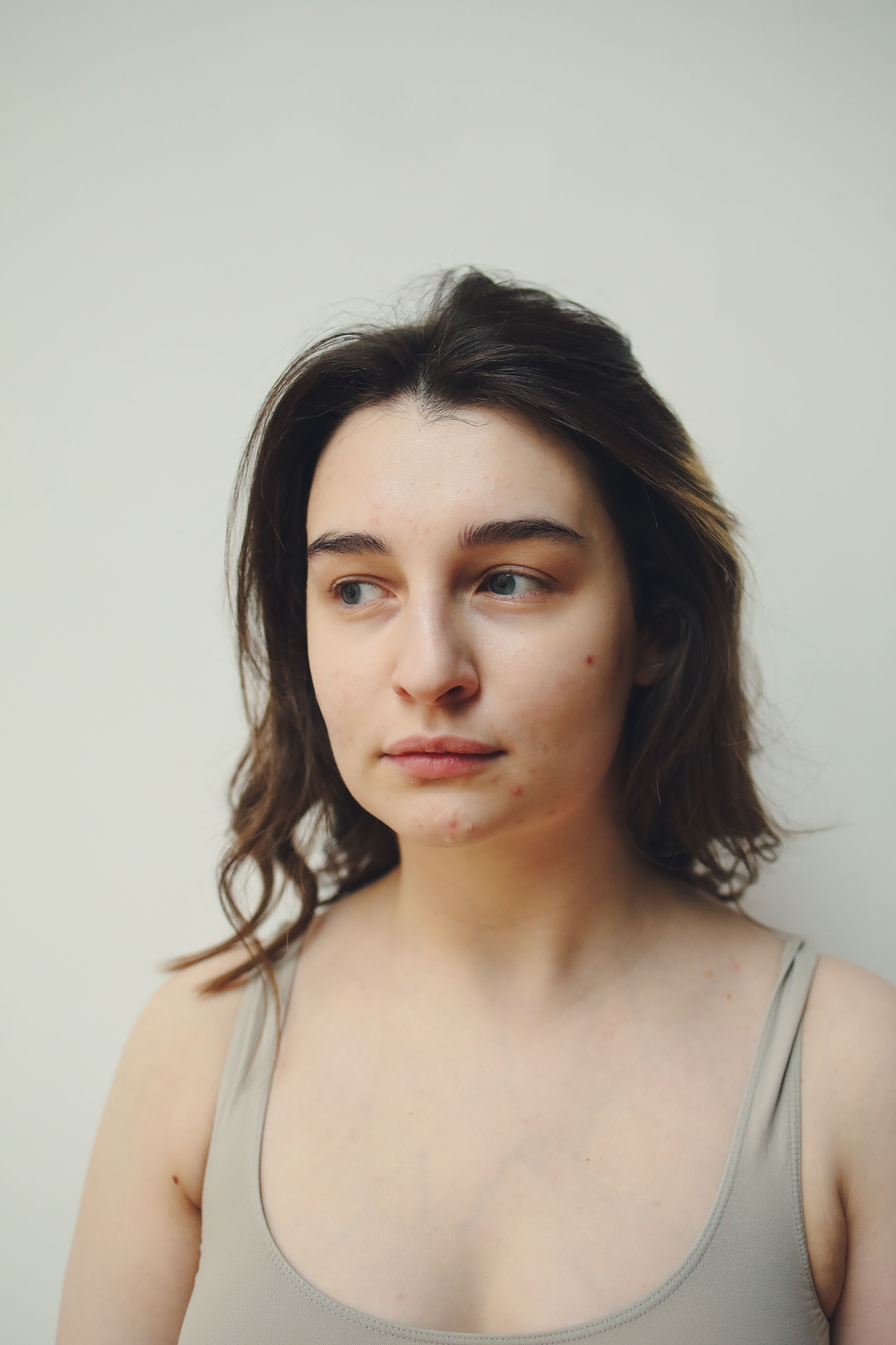 Woman with acne scarring and visible skin texture