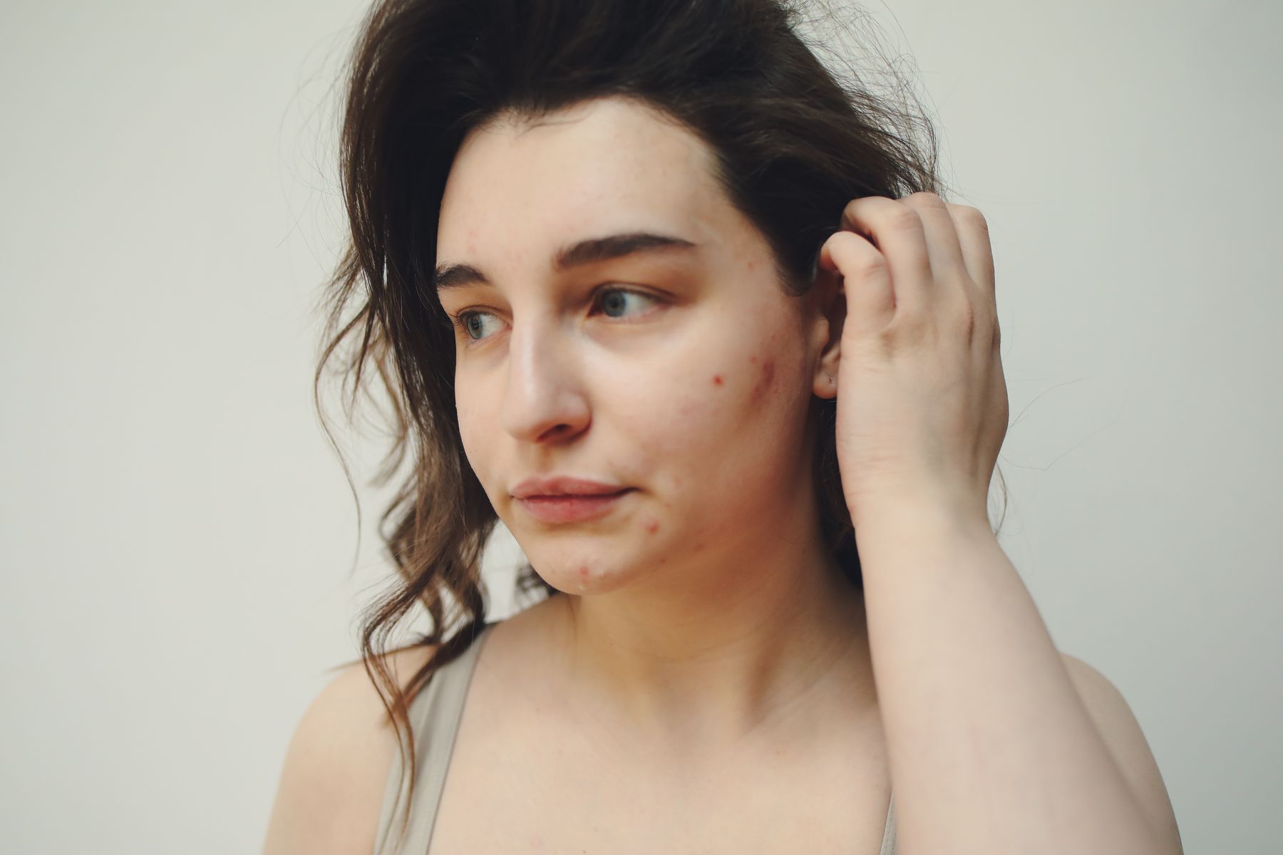 Woman with visible acne and acne marks