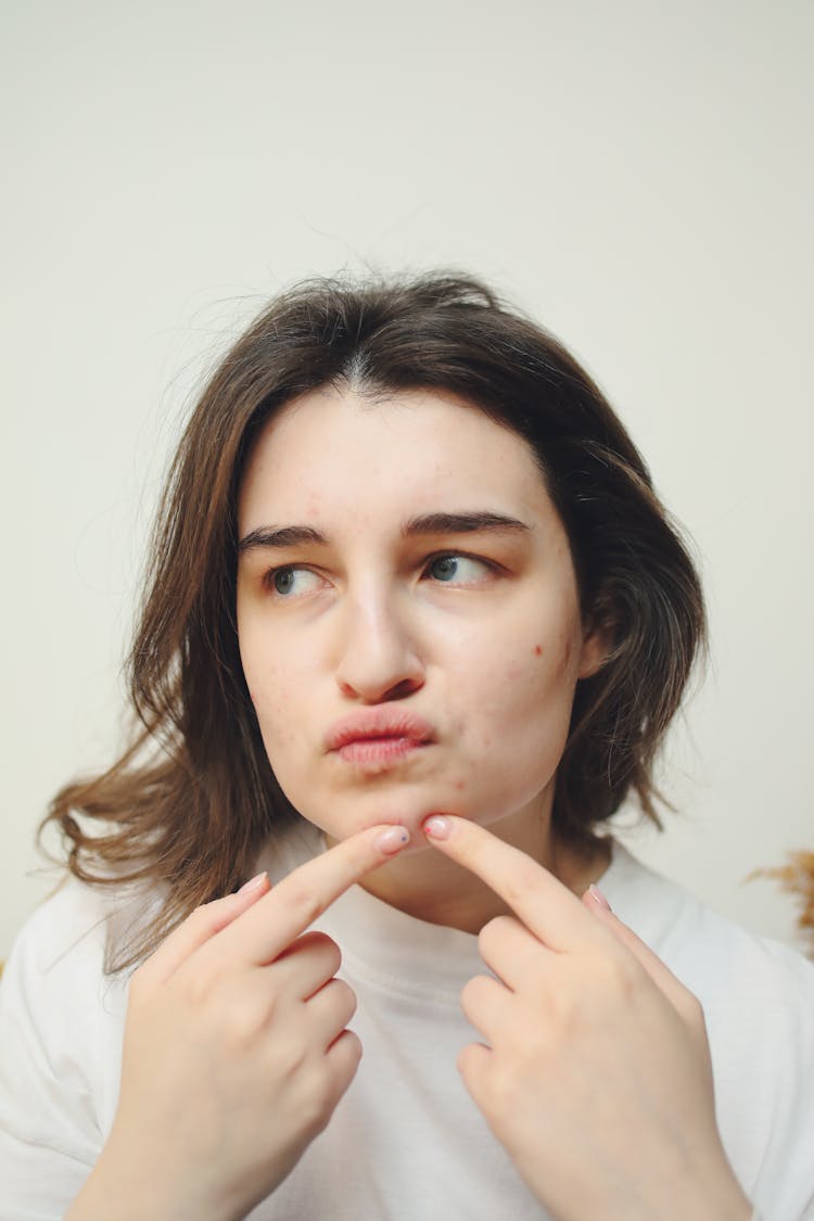 A Woman With Acne Touching Her Face 