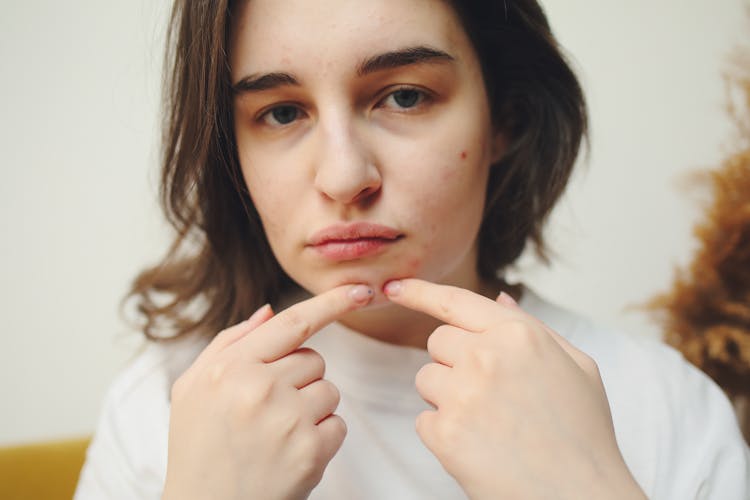 A Woman Popping A Pimple 