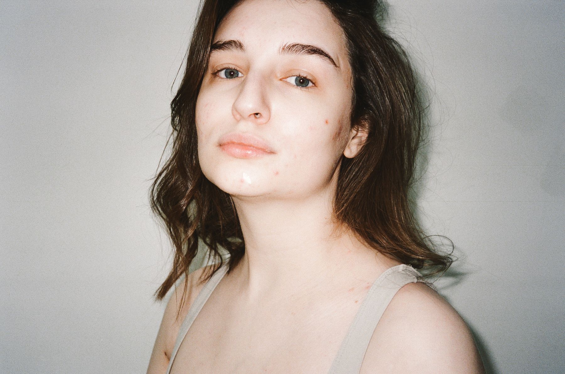 Beautiful woman with natural acne-prone skin