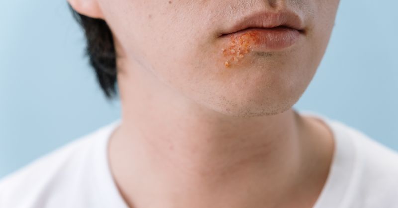 Bouton après rasage : 8 solutions efficaces