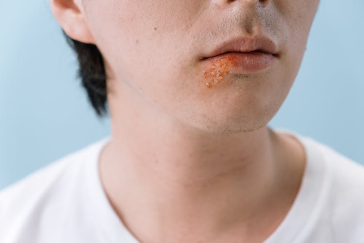 Skin Disease On Person's Face