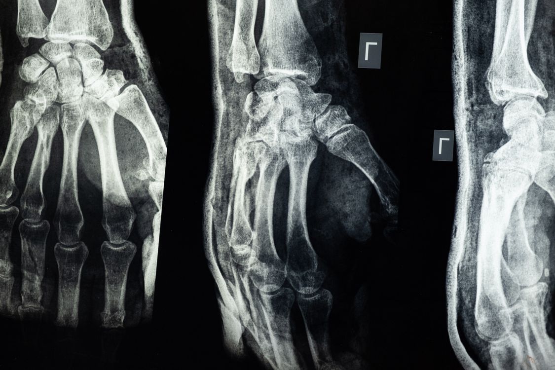 Orthopedics bone and joint care at Dwarkesh ICU & Trauma Center