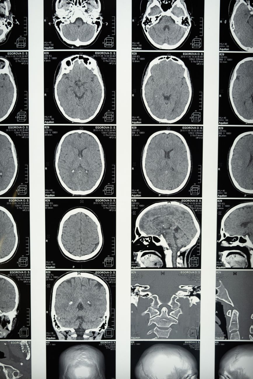 Brain Processes Speech While Unconscious: Study