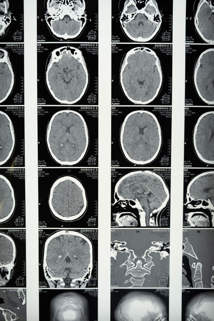 Tomografía Computada - Gantry Scanner CT