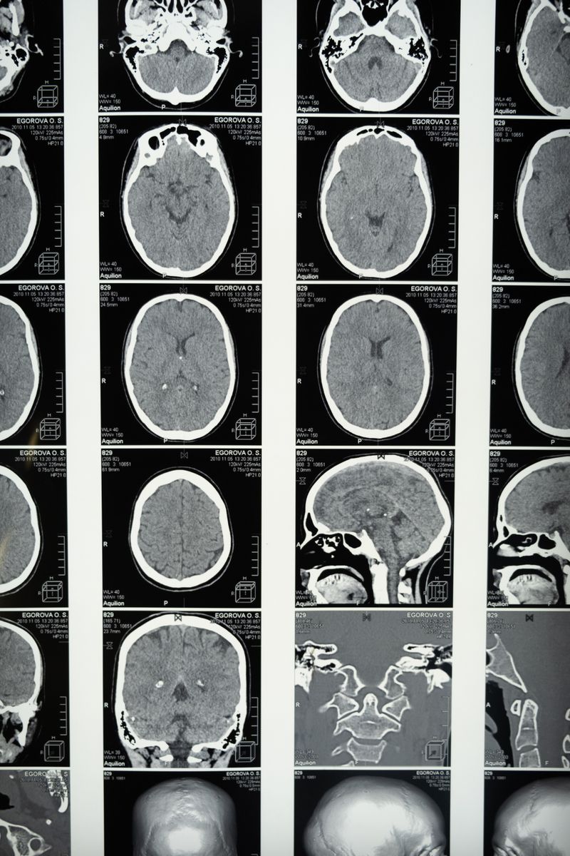 MRI brain scan showing neurological imaging used in dementia and Alzheimer