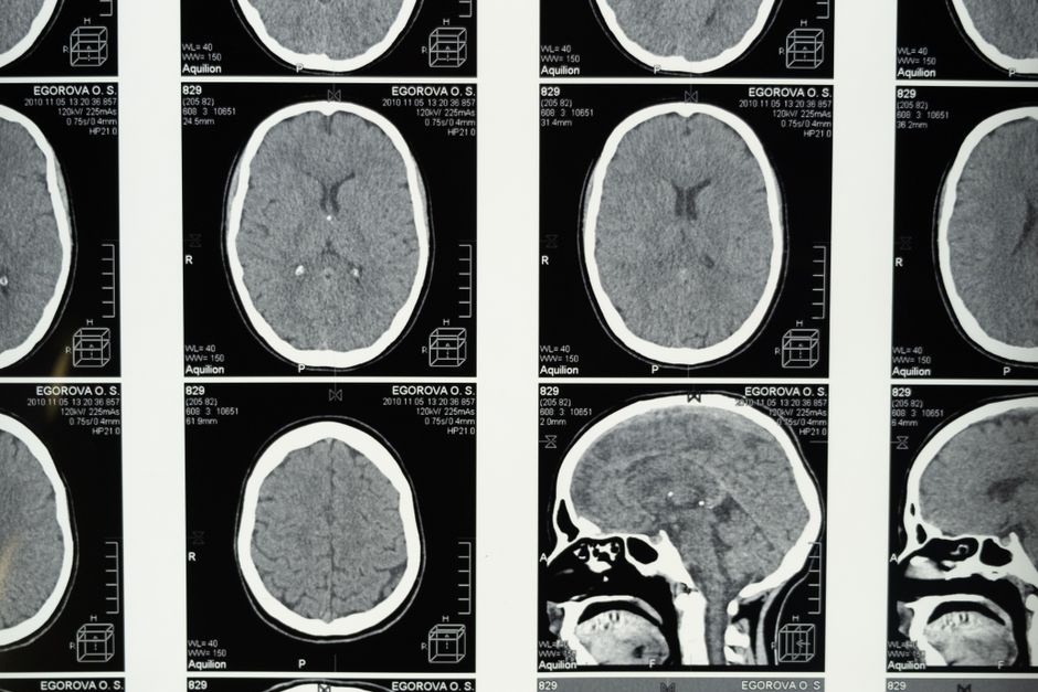 Medical brain scan images on a light board — ketamine blocks NMDA receptors while ibogaine acts on serotonin, dopamine, opioid, and sigma-2 receptors simultaneously