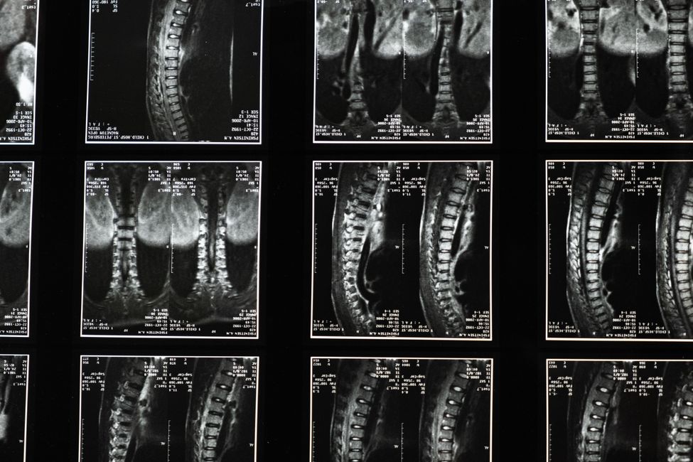 Picture for New spinal stimulation technique shows promise in reversing muscle wasting disease