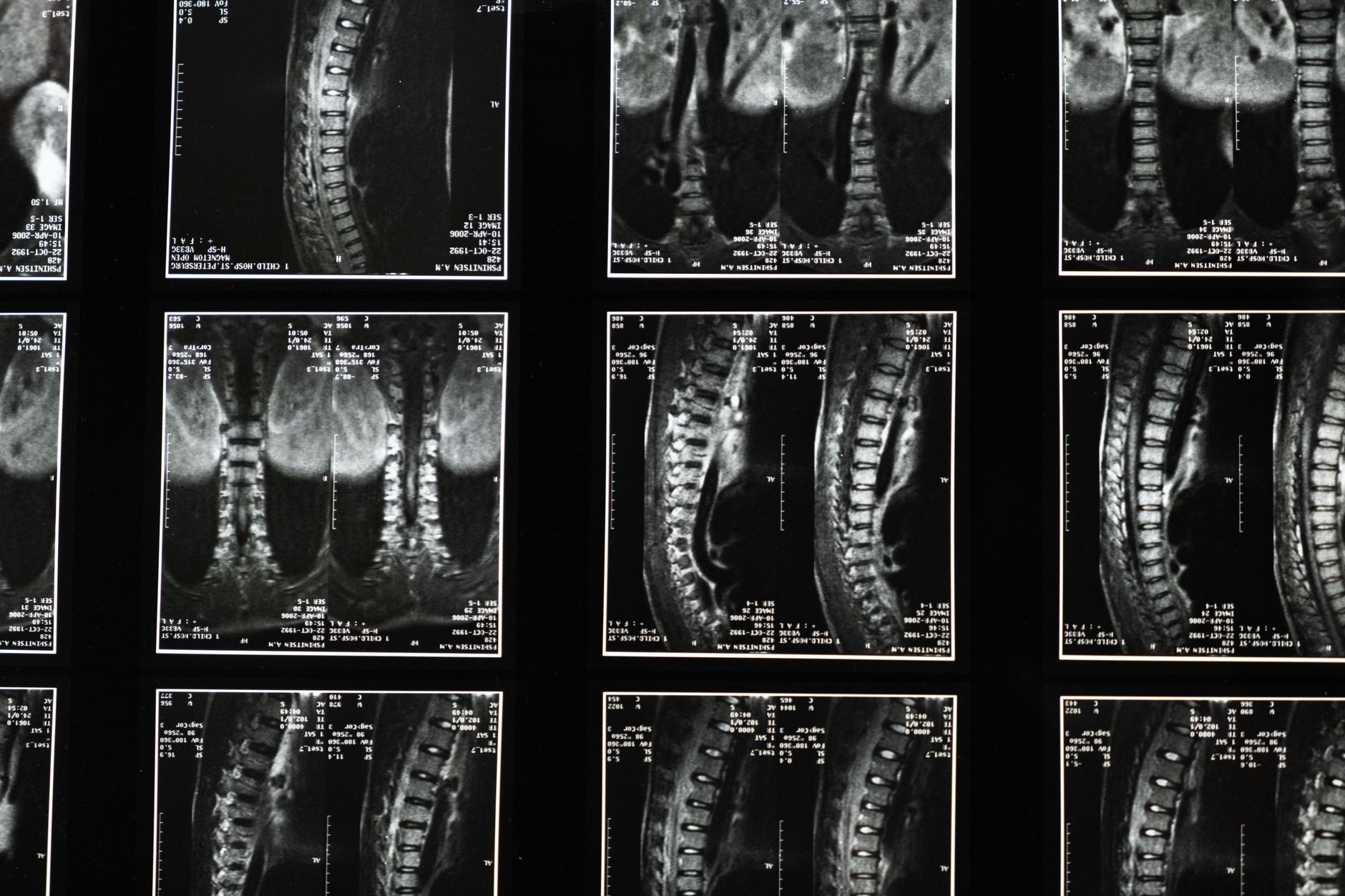 Fotos de stock gratuitas de alineación espinal, análisis médico, anatomía
