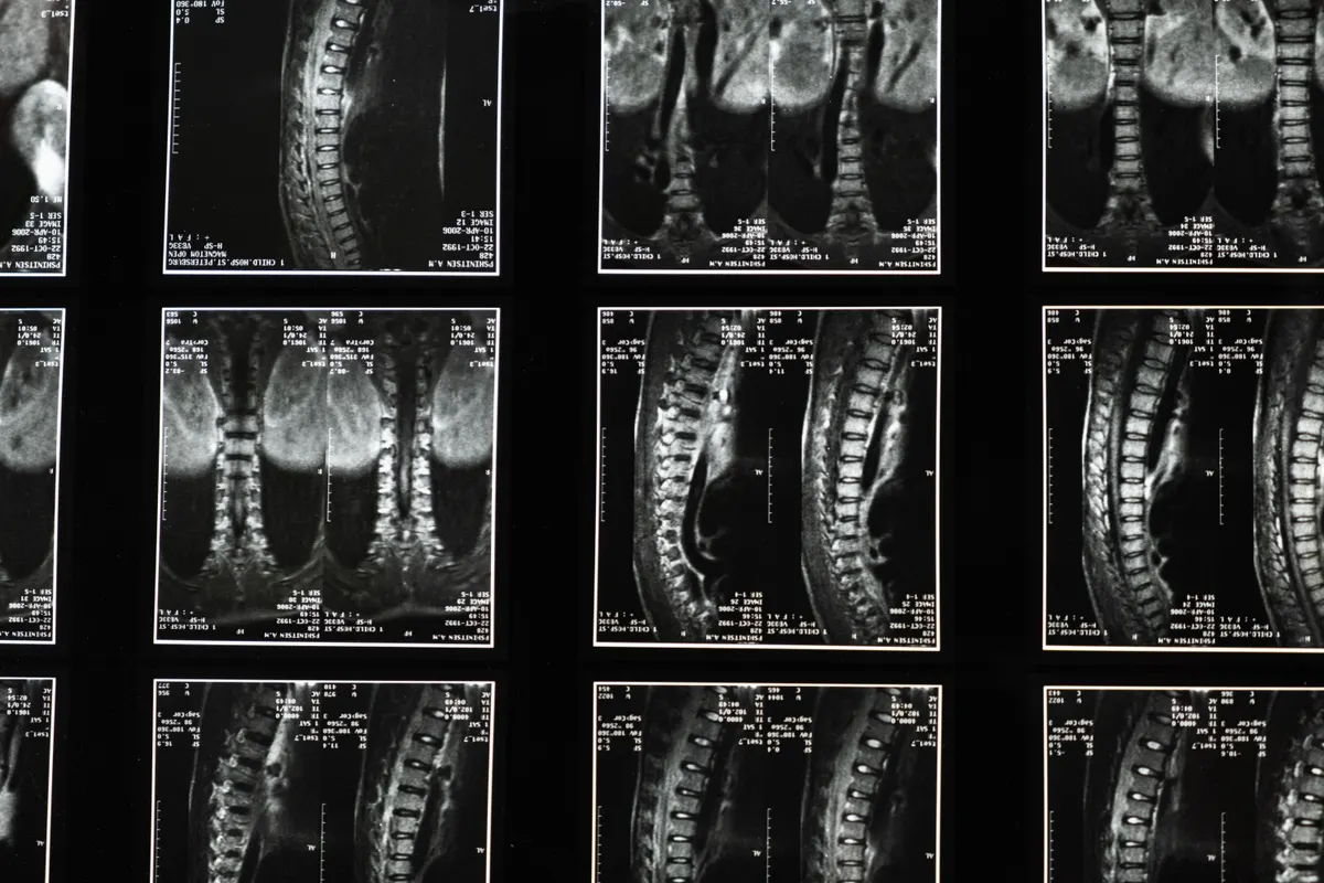 PRP vs Stem Cell Injections for Disc Degeneration: What the Clinical Evidence Shows