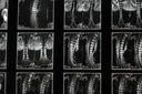 PRP vs Stem Cell Injections for Disc Degeneration: What the Clinical Evidence Shows