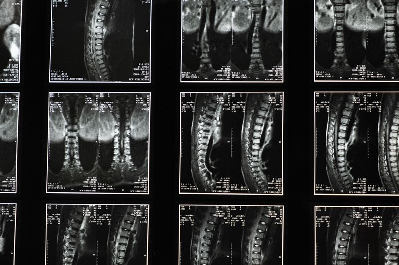 Detailed spine X-ray showing vertebral structure and disc spaces