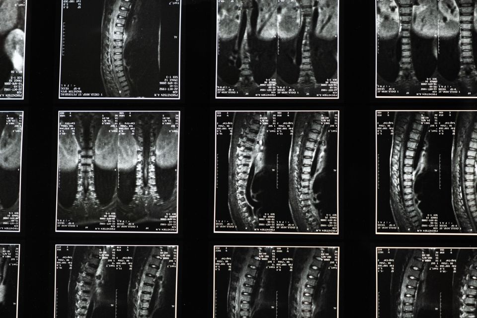 Spinal imaging used in scoliosis care