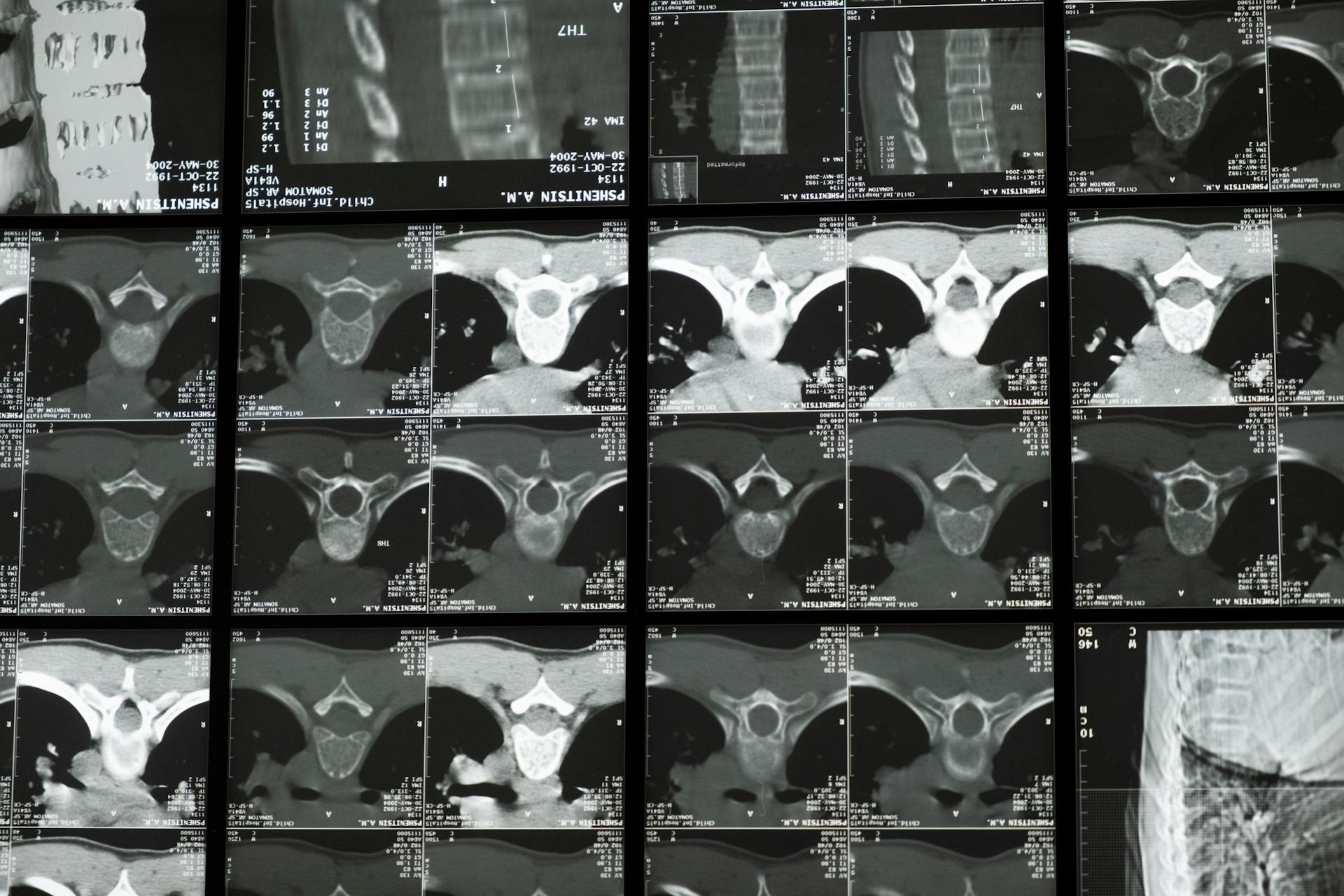 Medical Imaging Examination of the Spine