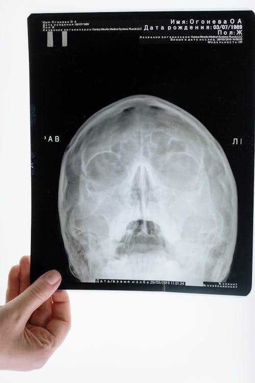 A Person Holding an X-Ray of the Head