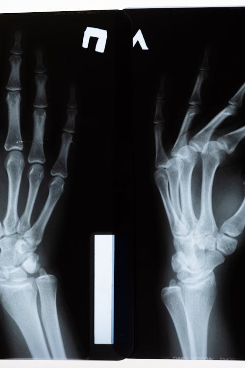 Free X-Ray of the Hands Stock Photo