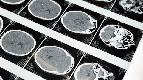 Detailed brain MRI scans displayed on a lightbox, showcasing medical imaging techniques.