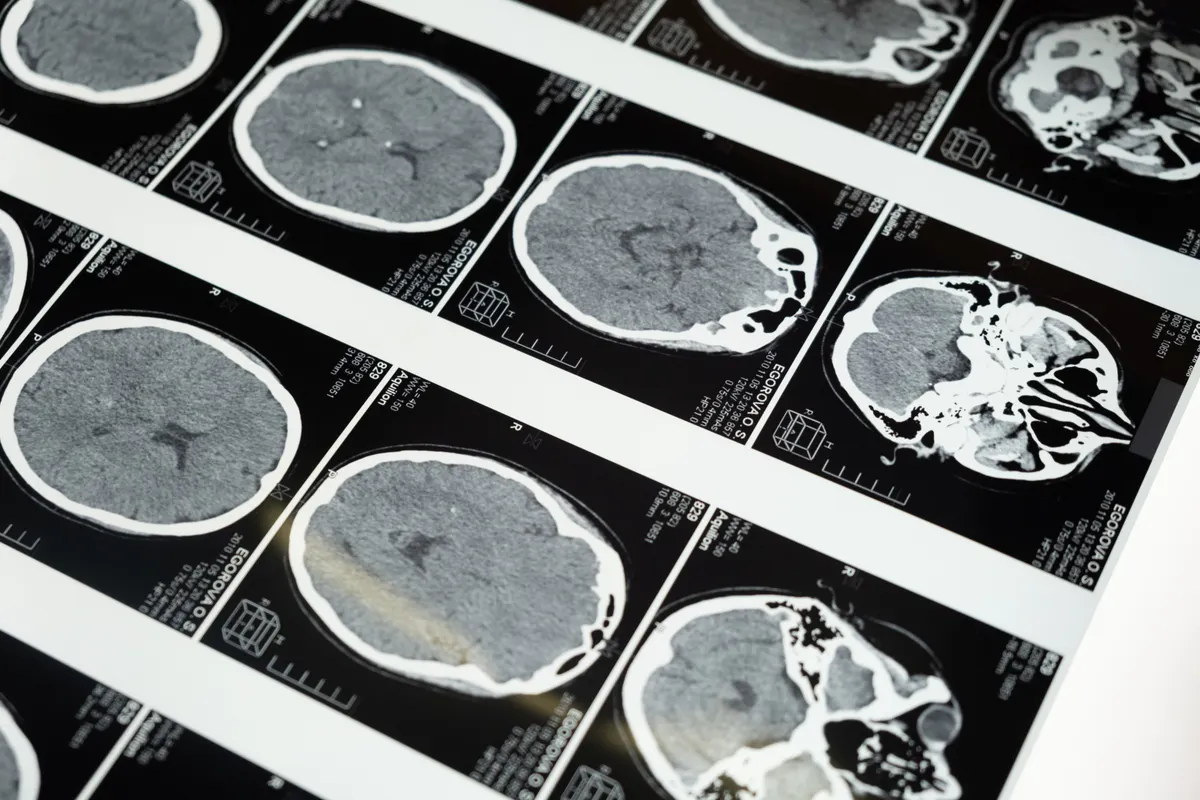 How to Shield Your Brain from Early Aging and Keep Your Mental Edge Sharp