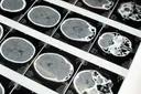 NK Cell Therapy for Glioblastoma: New Research on Overcoming Resistance