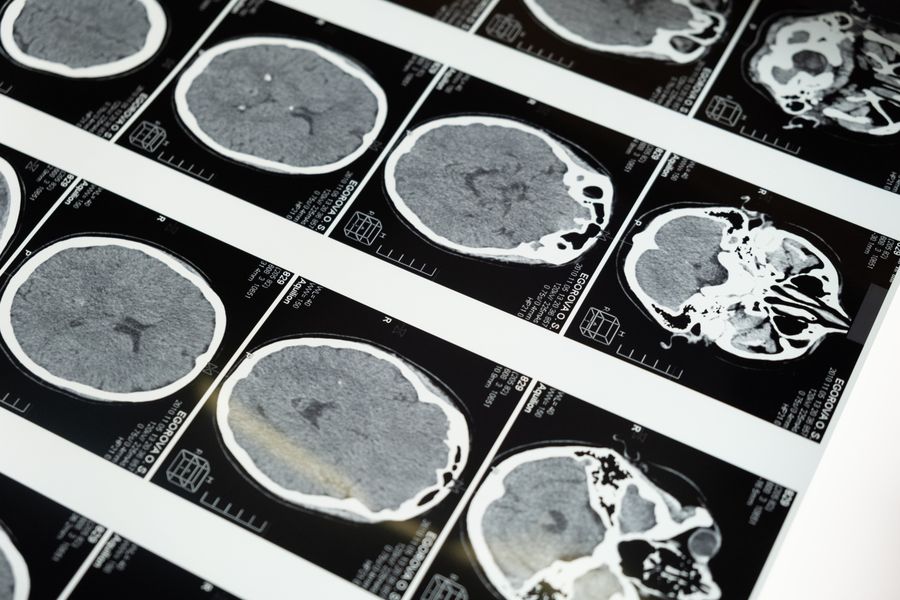 Brain MRI scans on a lightbox — the perfusion and SPECT imaging used to measure cerebral blood flow in HBOT cognition trials