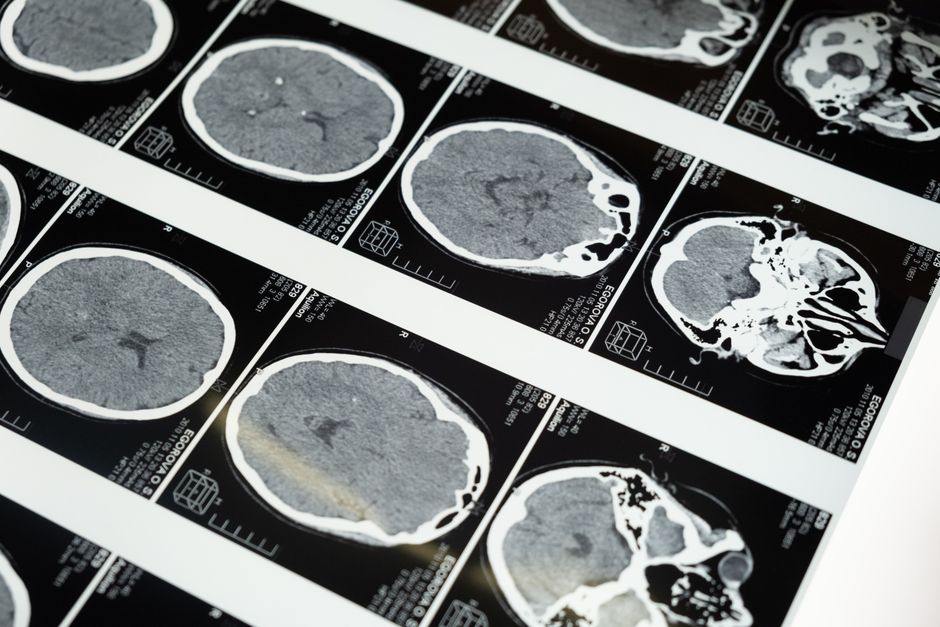 MRI brain scan images on a lightbox — the structural changes ibogaine produces are now visible in human neuroimaging