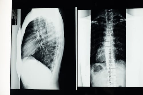 Gratis Fotos de stock gratuitas de anatomía, columna vertebral, escoliosis Foto de stock