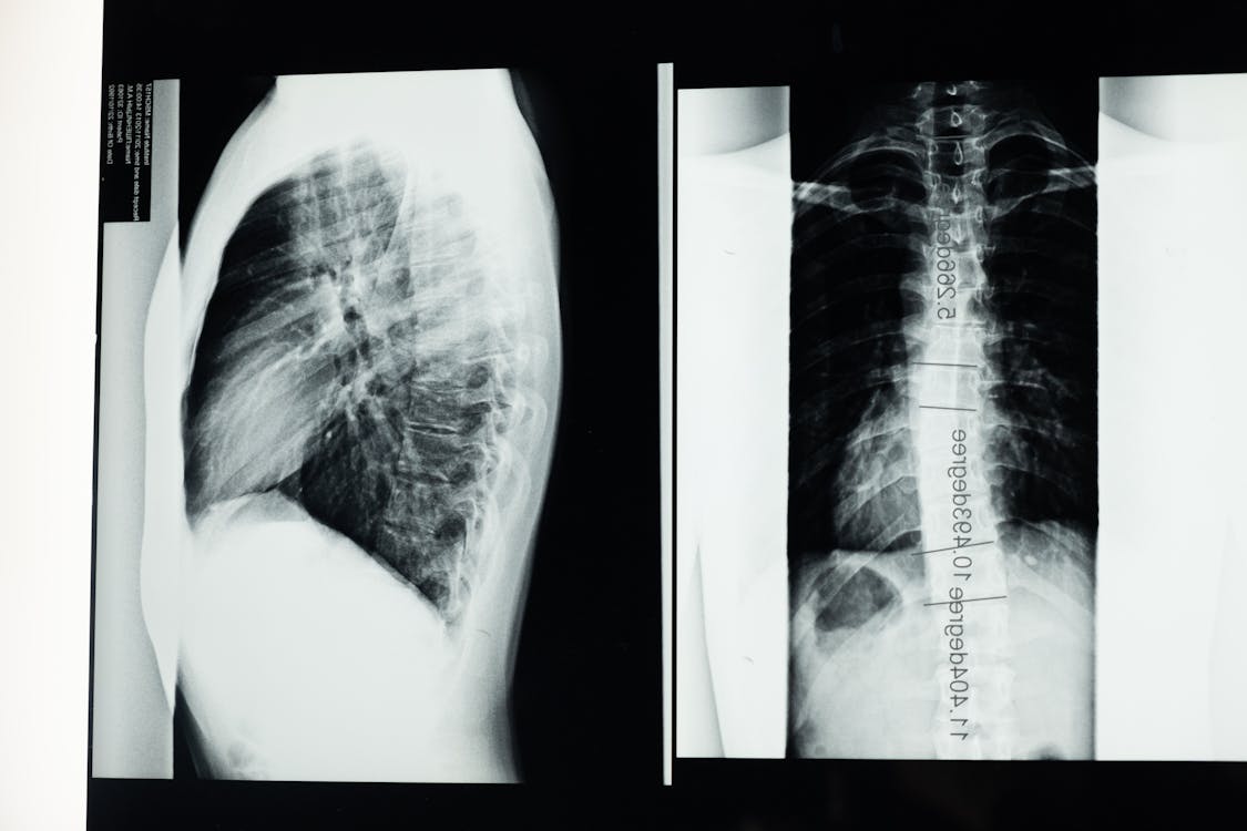 Free X-Ray Images of the Spine Stock Photo