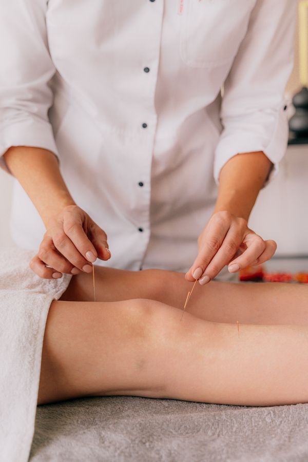Fines aiguilles de dry needling posées autour du genou