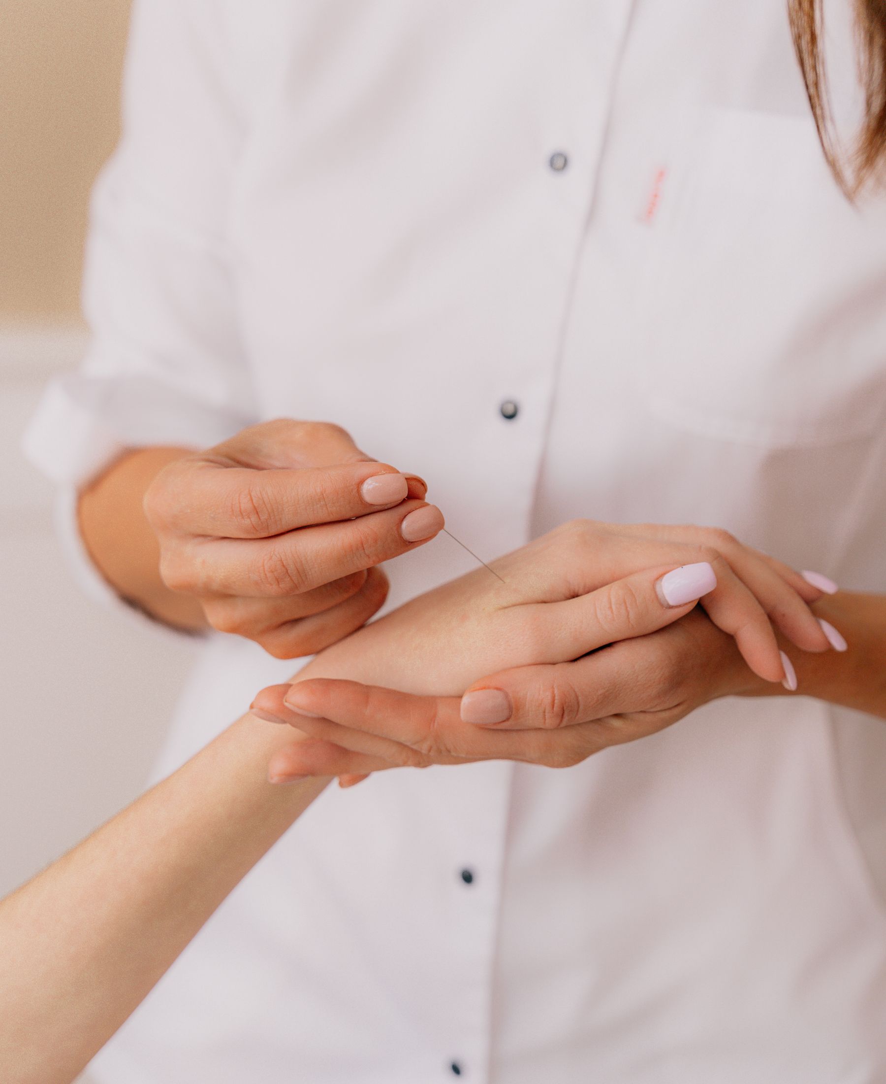 A practitioner's hands placing an acupuncture needle in a patient's hand.