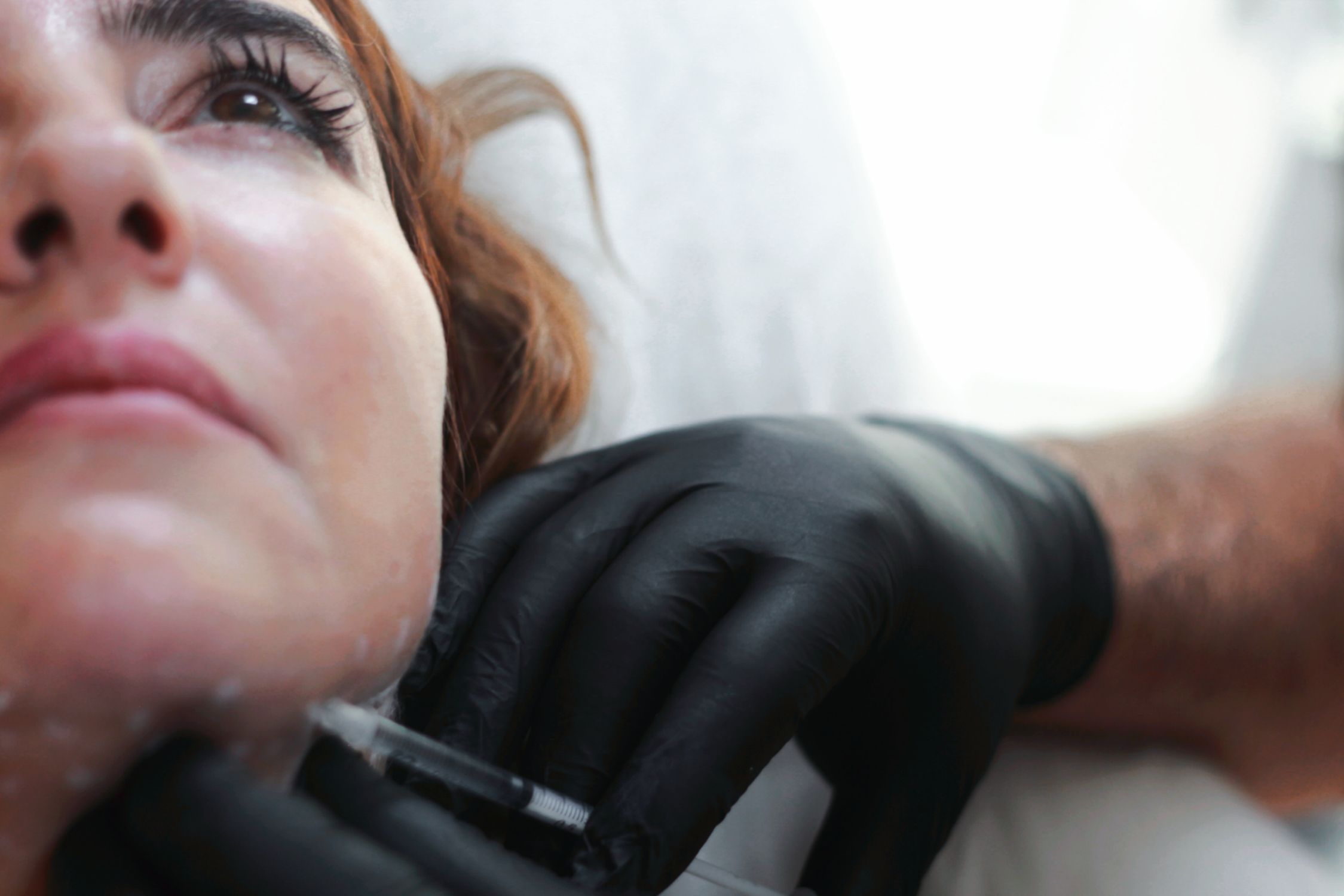 Close-up de uma mulher recebendo injeção de preenchimento dérmico por um profissional com luvas pretas.