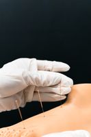 Spierpijn en triggerpoints, dry needling