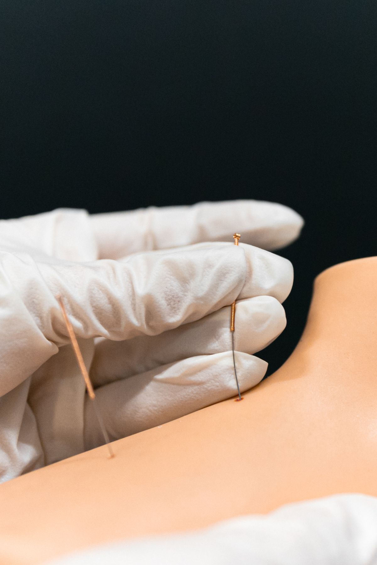 Pregnancy Acupuncture Suitable From 4 To 37 Weeks