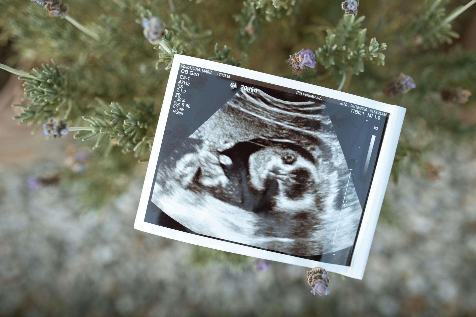 Close-Up Shot of a Sonogram