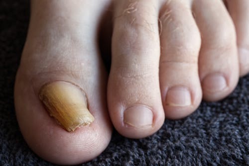 Free stock photo of anatomy, anomaly, big toe
